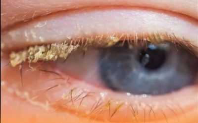 Crosta giallastra al risveglio: cosa significa?