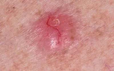 Basocellulare carcinoma, ecco i sintomi a cui prestare attenzione (1 / 2)