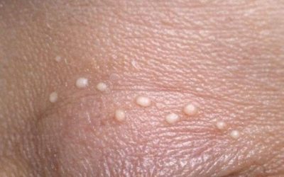 Sulle mie palpebre continuano a comparire delle piccole protuberanze bianche e non sono ancora riuscita a farmi visitare. Cosa sono?