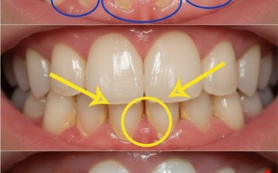 Sostituzione miracolosa della placca dentale naturale: come un dentista può rimuovere la placca dentale in un minuto