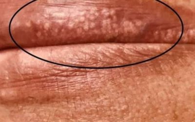 Quando consultare un dermatologo per i punti bianchi