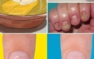 Chiamato « Fungus Buster »: elimina i funghi alle unghie e i calli dei piedi in una sola passata