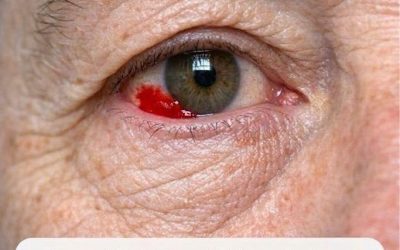 Mio marito, di 64 anni, si è svegliato con una macchia rosso sangue sull’occhio. Dovremmo andare in ospedale?