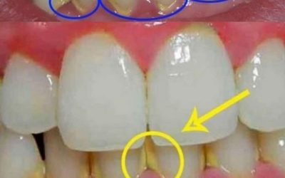 “Rimuovi la placca in 5 minuti in modo naturale, senza andare dal dentista! Scopri questo segreto per un sorriso smagliante.