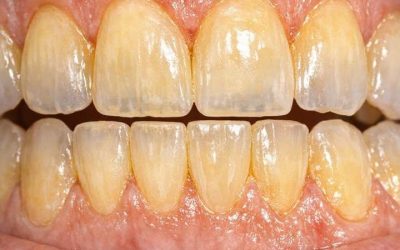 I miei denti continuano a diventare più gialli anche se li lavo due volte al giorno. Perché non rimangono bianchi?