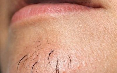 La presenza di peli sul mento in una donna è un segno di…Vedi altro