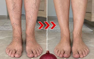 Il rimedio naturale che riduce le vene varicose e migliora la circolazione in poche settimane