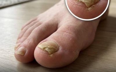 I tuoi piedi, quei messaggeri discreti: due problemi silenziosi che possono tradire e come reagire in tempo